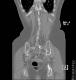 CT colon 43
